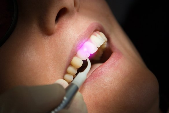 terapia parodontale laser